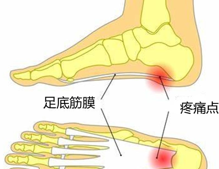 夏天的洞洞鞋，你中招了吗？