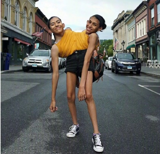 美国连体双胞胎共用身体25年，姐姐近期官宣结婚，妹妹怎么办？