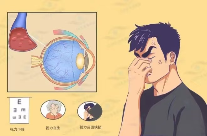 眼睛也会 “中风”？高三女生因此永久失明，黄金 4 小时别错过！