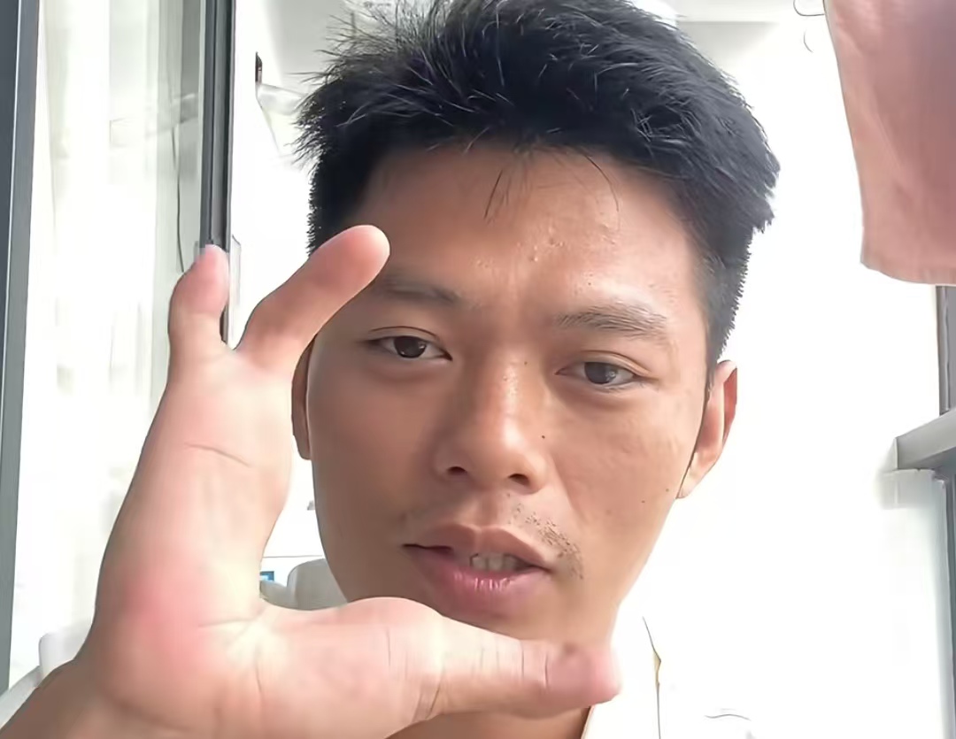 湖南 90 后长 “龙虾手”，妈妈天生聋哑！外公外婆竟是亲堂兄妹