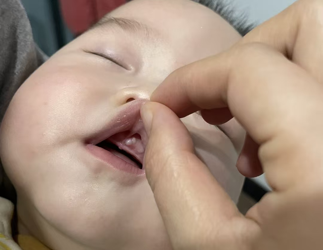 吓人！2 个月宝宝进 ICU，竟因奶奶擦了牙龈上的 “小白点”，很多老人都犯过这错