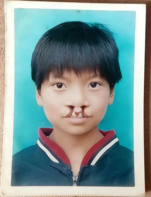 漂亮女孩晒唇腭裂手术旧照声援李亚鹏：她的勇气震动全网