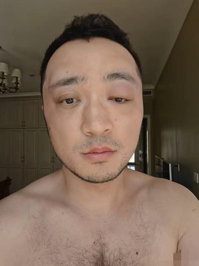 尼格买提晒过敏照引热议：染发风险再被提醒