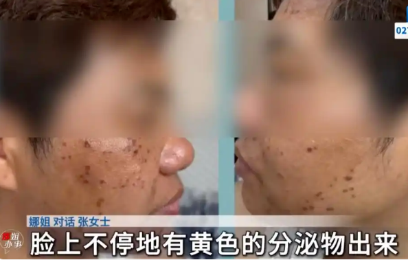 276 元团购淡斑暗藏大坑！店员威胁半小时不交 1 万，不然直接毁容