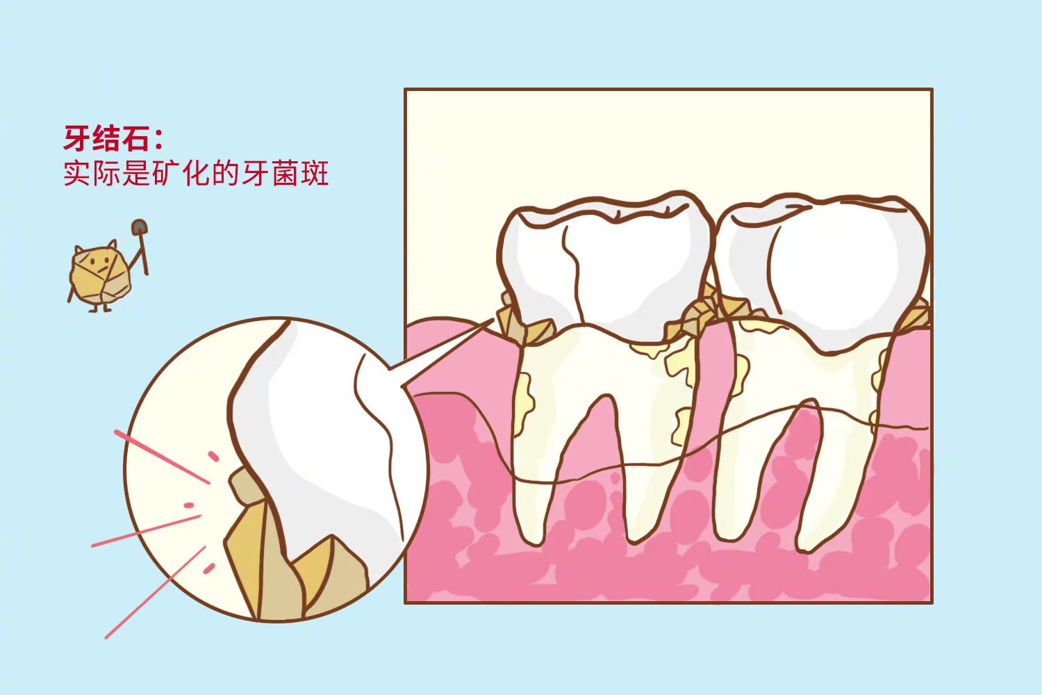大误区！洗牙后牙缝变大不是洗坏牙？原来一直被牙结石骗了！