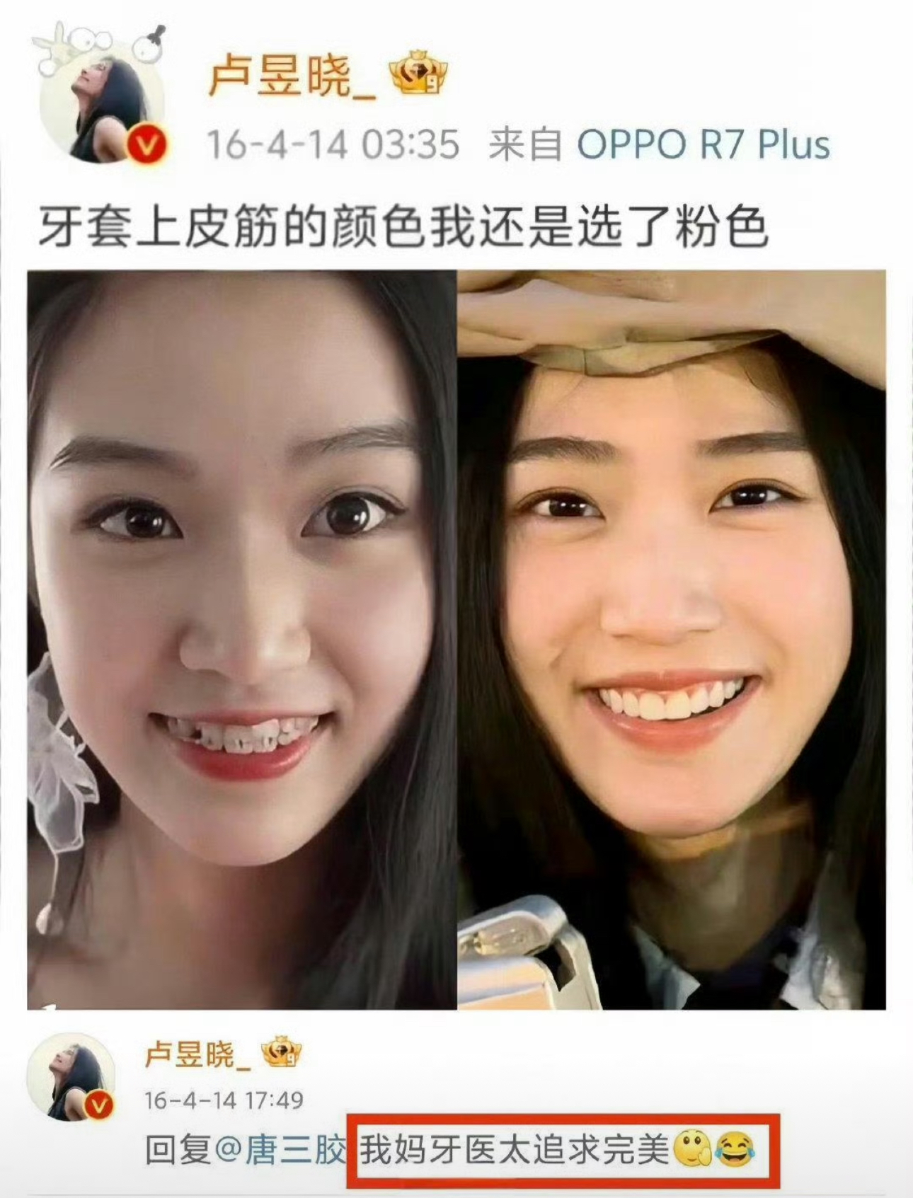 考古！卢昱晓 2016 年的牙套动态，放到现在依旧是整牙圈热议范本